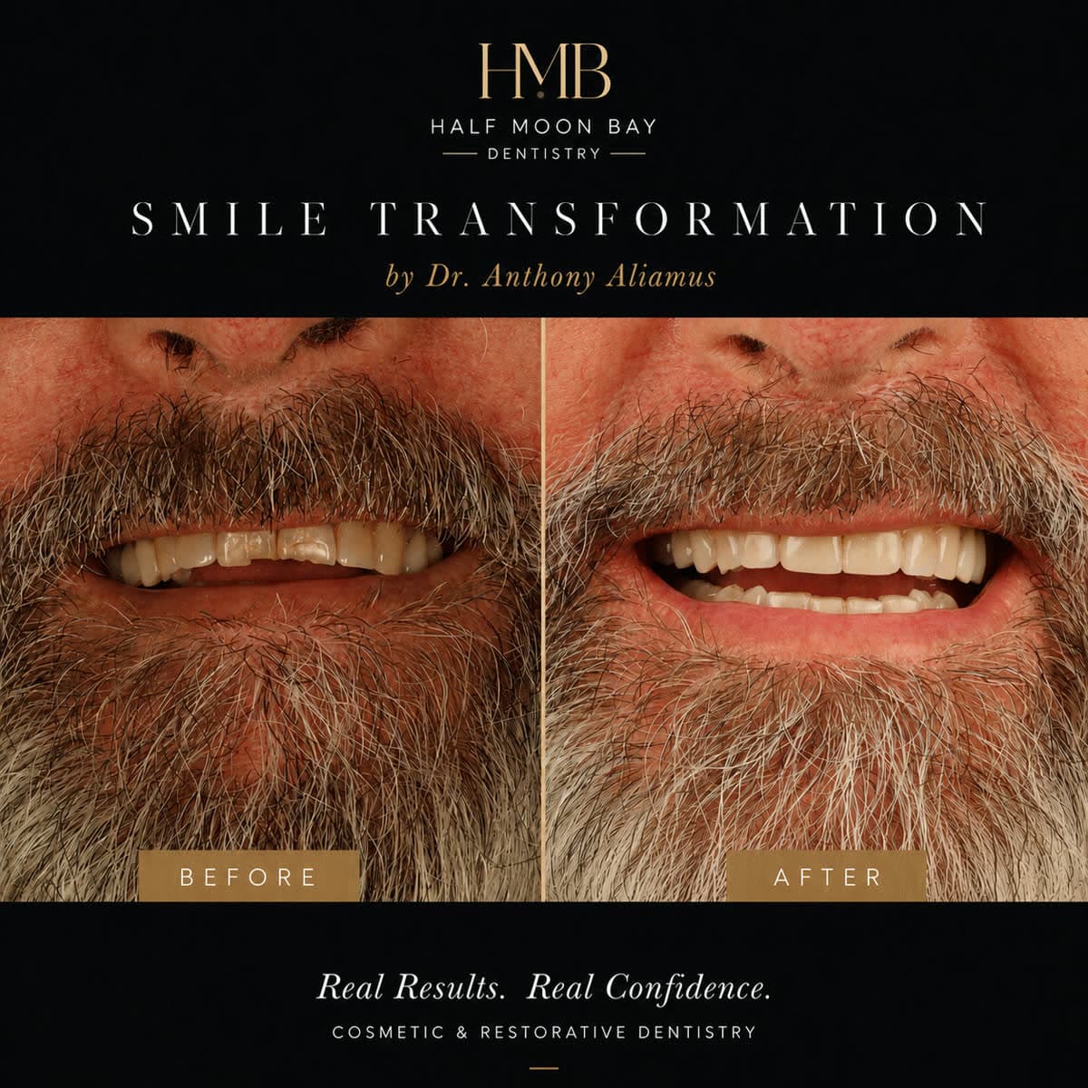 Before and after smile transformation by Dr. Anthony Aliamus